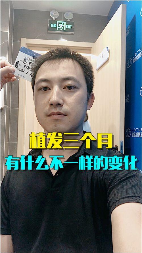 直播爆料二哥植发视频,二哥植发前后对比，效果惊人！